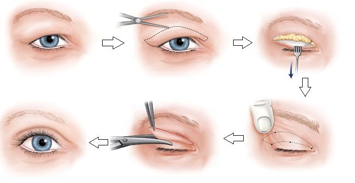 Quy trình cắt mắt 2 mí Plasma