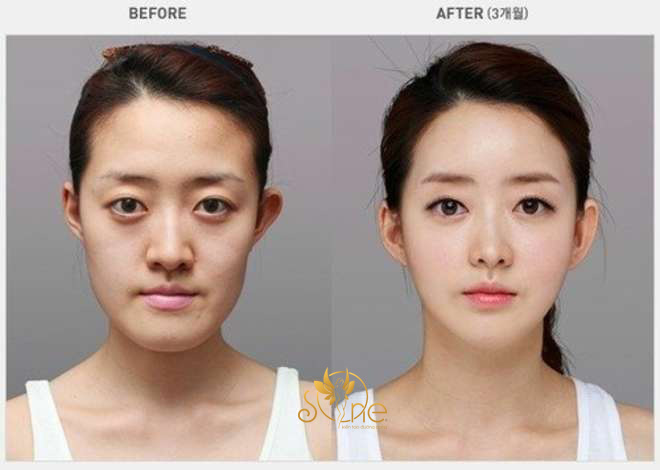 Hình ảnh trước và sau khi gọt hàm tại Viện thẩm mỹ S-ONE