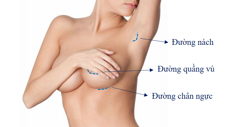 Nâng ngực nội soi