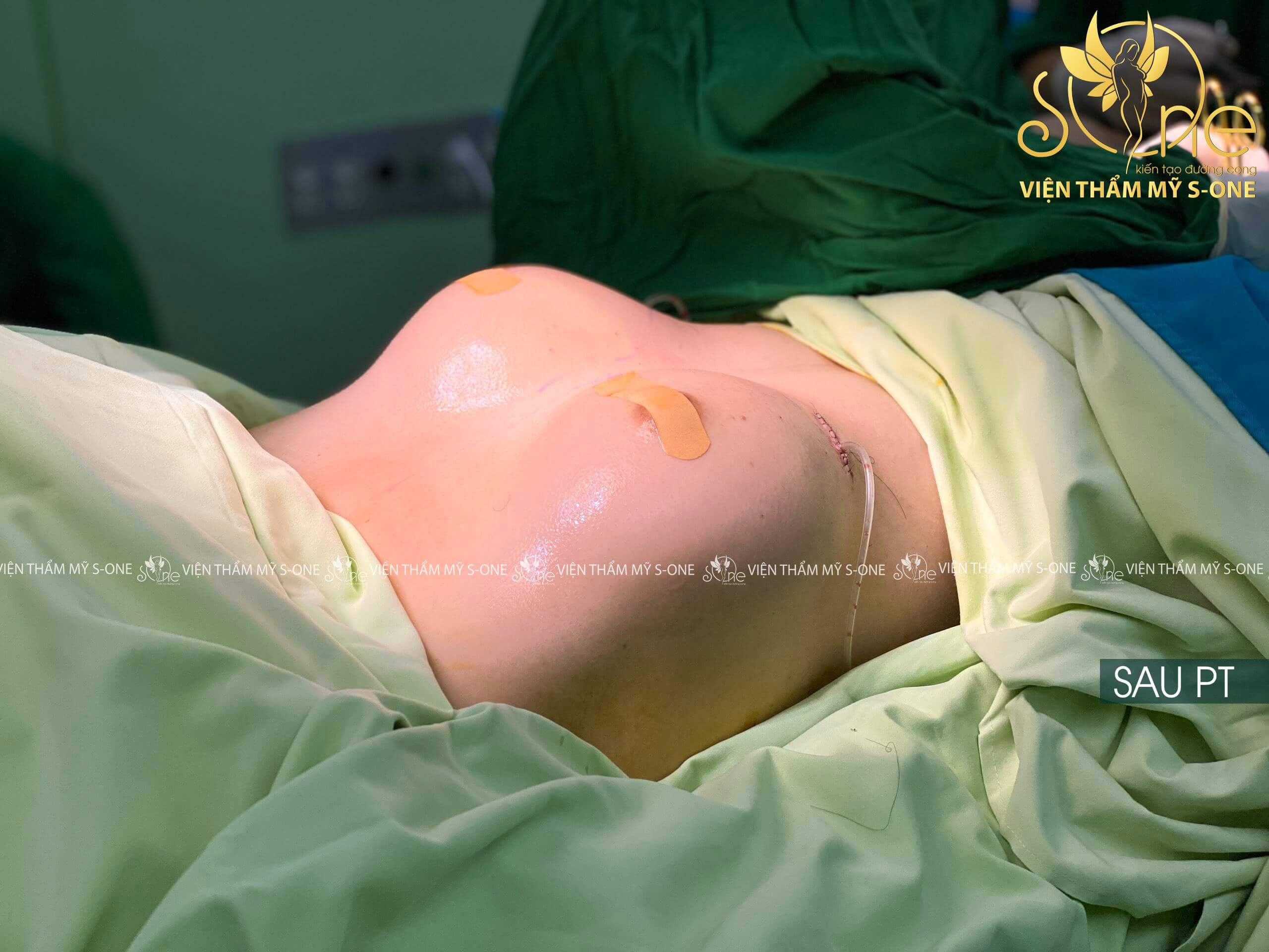 video phẫu thuật nâng ngực nội soi