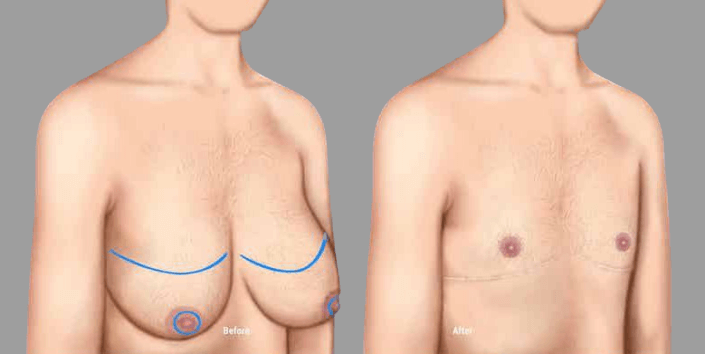 phẫu thuật cắt bỏ ngực chuyển giới