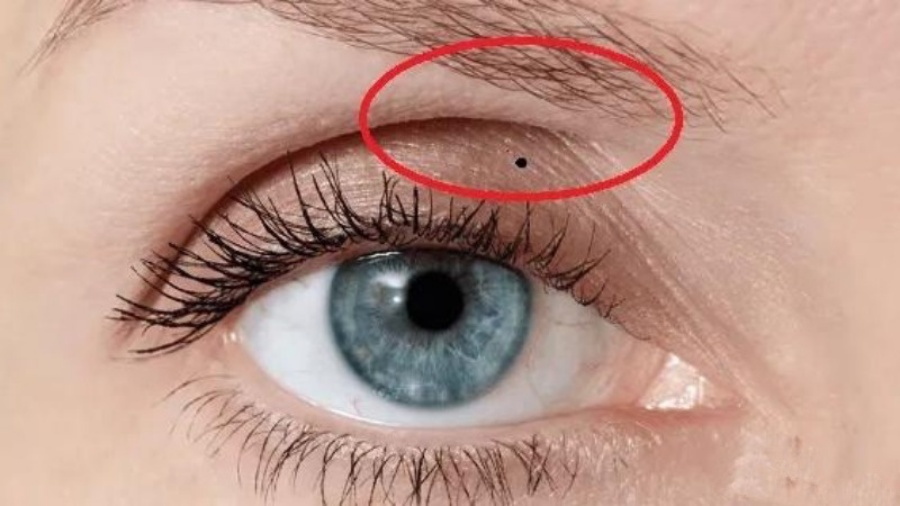 Nốt ruồi ở trong mí mắt phải